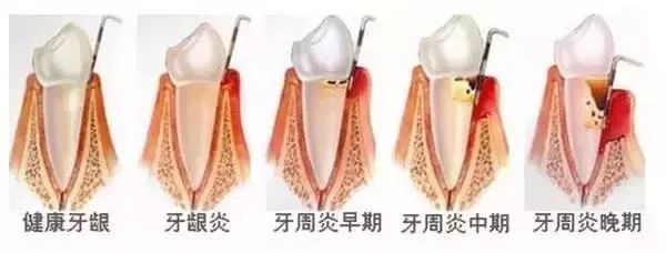 孩子換牙八字牙